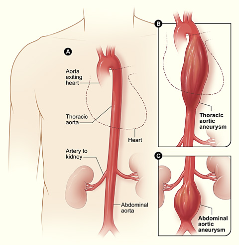 Description: https://upload.wikimedia.org/wikipedia/commons/0/0b/Aortic_aneurysm.jpg